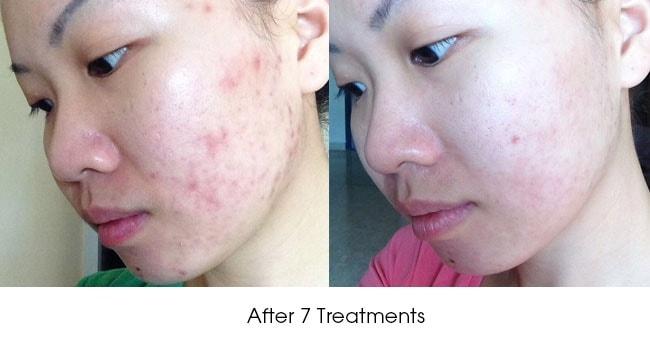 https://www.cambridgetherapeutics.com.sg/resources/ck/images/Before-After-Acne-calvy4.jpg