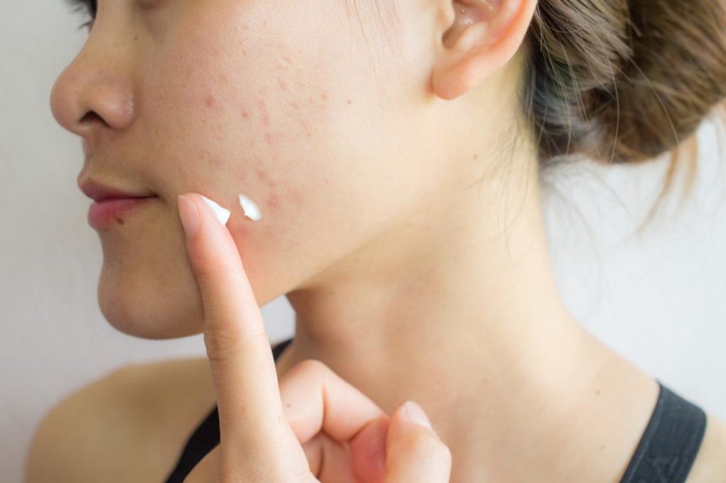 Boost Your Confidence With these Tried and Tested Acne Scar Removal